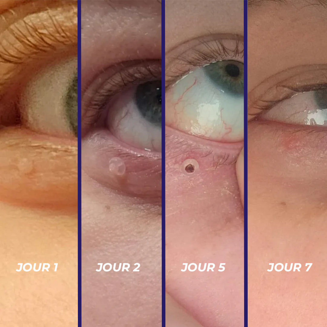 TagPal – Kit de suppression des excroissances cutanées